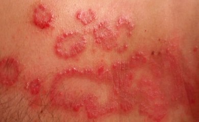 Risk Factors Of Bacterial Gastroenteritis