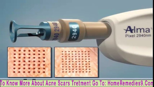 Acne Scars Treatment - Pixel Laser Skin Resurfacing Treatment For Acne Scar BestDramaTv.Net