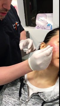 TCA Cross / Acne Scar Treatment Beverly Hills, CA / Asian Skin / Chemical Peel For Acne BestDramaTv.Net