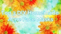 Top 3 DIY Homemade Acne Face Masks | How to Get Rid of Acne & Acne Scars FAST!! http://BestDramaTv.Net