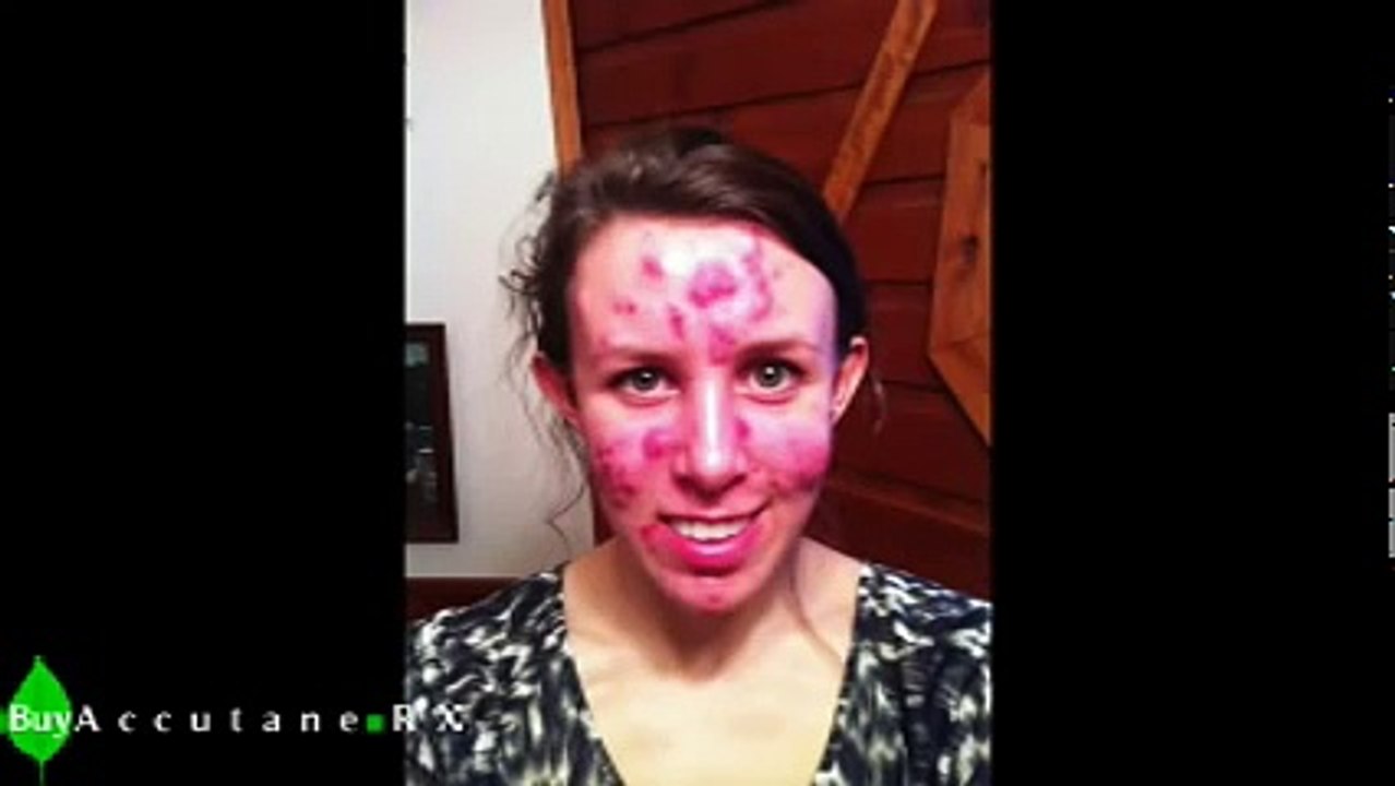 My Acne Story & Accutane Journey | Before & After | No Makeup http://BestDramaTv.Net