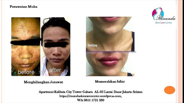 0811 1721 280, Agar Payudara Kencang di Jakarta Selatan Rinanda Skin Care Center
