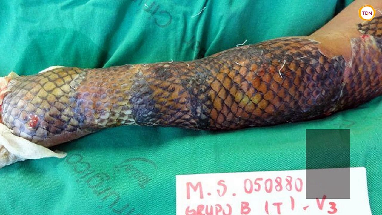 La peau de tilapia très bénéfique pour les grands brûlés