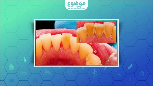 #موضوع: إزالة جير الأسنان