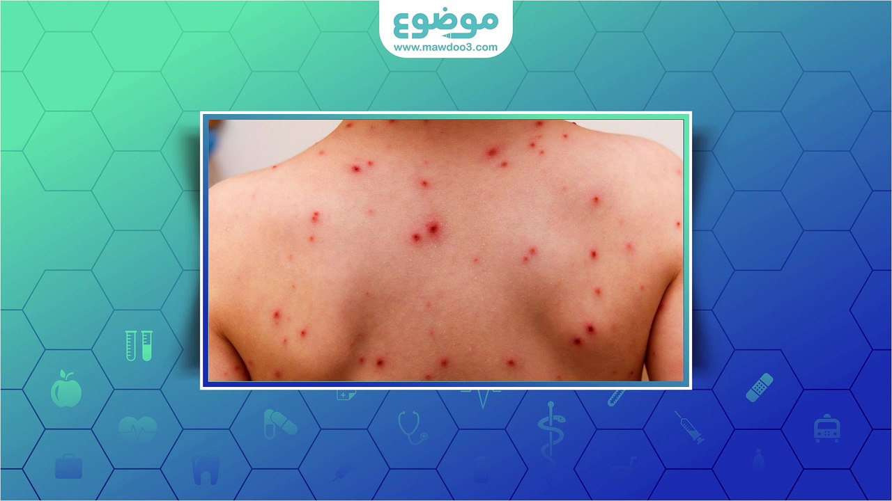 #موضوع: ما هو جدري الماء؟