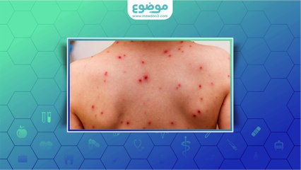 #موضوع: ما هو جدري الماء؟