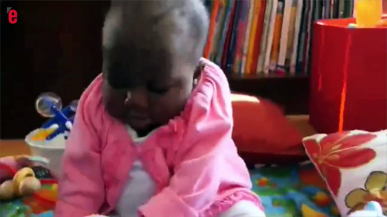 Une petite fille née avec 4 jambes, opérée avec succè