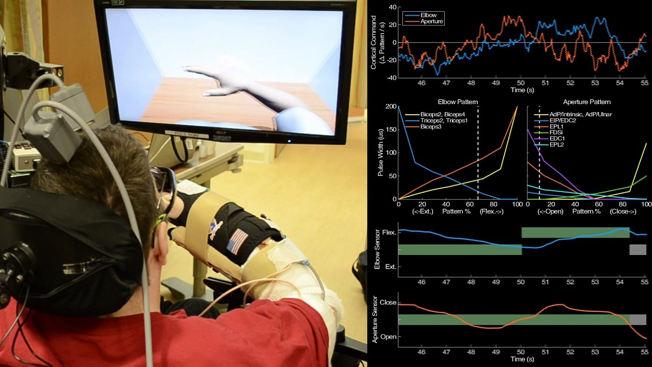 Paralysed man moves arm with thought-controlled technology