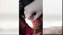 Nena con mal aliento. Odontólogo le extrae gusanos