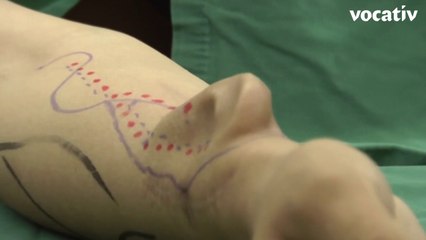 Ear Transplanted From Man’s Arm To Head