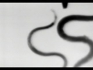 Hookworm Disease Symptoms & Treatment Film (1922)