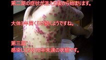 【閲覧注意】梅毒患者の症状の末期がヤバすぎる、日本で近年増加しているけど予防法・治療法は？【グロ注意】