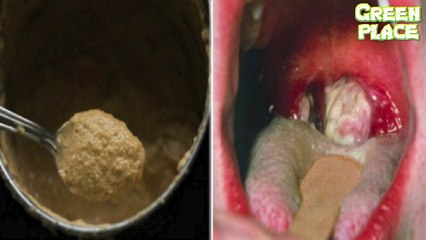 SORE THROAT CURING AND TONSILLITIS REMOVAL. Only In Few Hours With An Amazing Mix!!