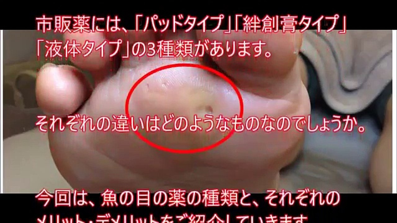 【閲覧注意】魚の目の芯を抜く？「イボコロリ」で自宅治療してみた 正しい治療・除去方法は？手術の必要はある？