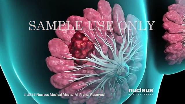 Breast Cancer _ Breast Biopsy