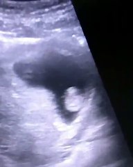 Yuk Cari Tahu Usia Kehamilan 2 Bulan