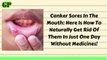 CANKER SORES IN THE MOUTH: Here Is How To Naturally Get Rid Of Them In Just One Day Without Medicine