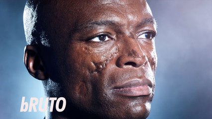10 Impressionantes Cicatrizes de Famosos