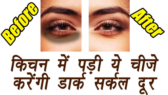 Dark circle home remedis, आंखों के काले घेरे दूर करेंगी किचन में पड़ी ये चीजें | BoldSky