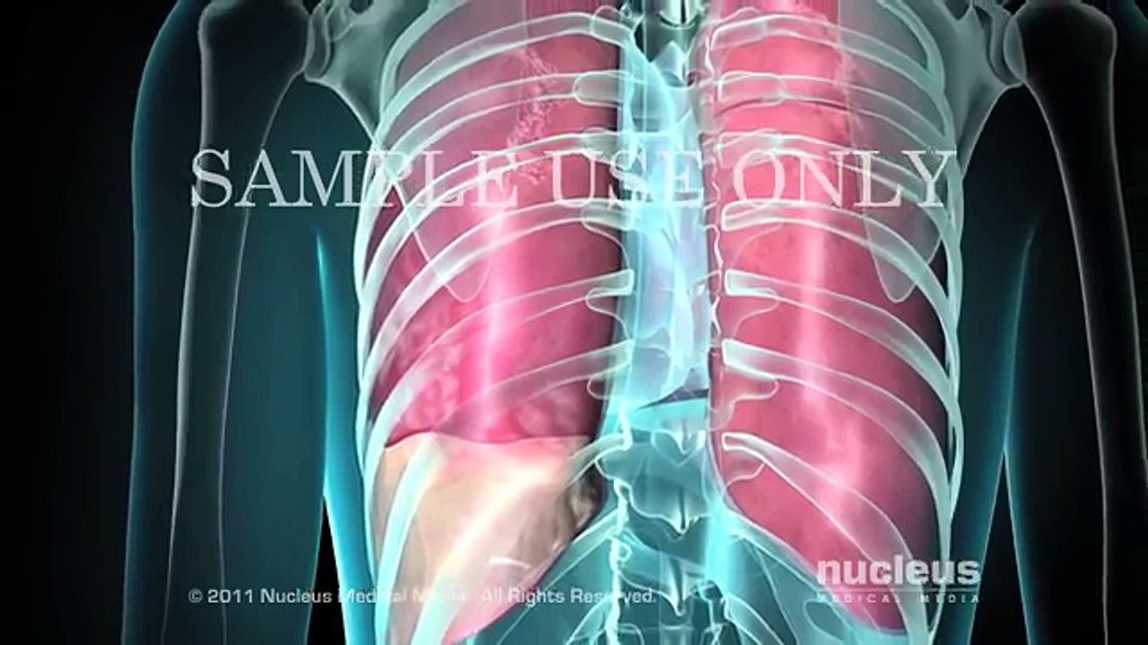 Lung Biopsy (TNB)