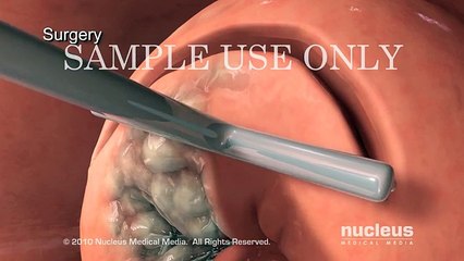 Treatments for Cervical Cancer