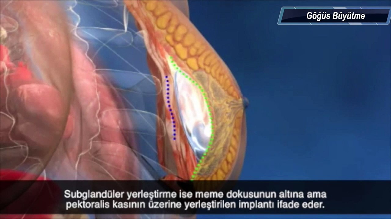 Göğüs Büyütme Ameliyatı ve Silikon Ameliyatı