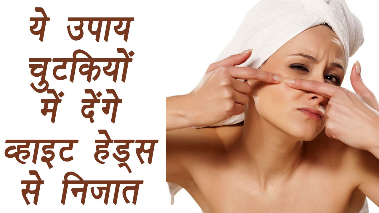Whiteheads removal tips, व्‍हाइटहैड्स दूर करने के घरेलू उपाय | BoldSky