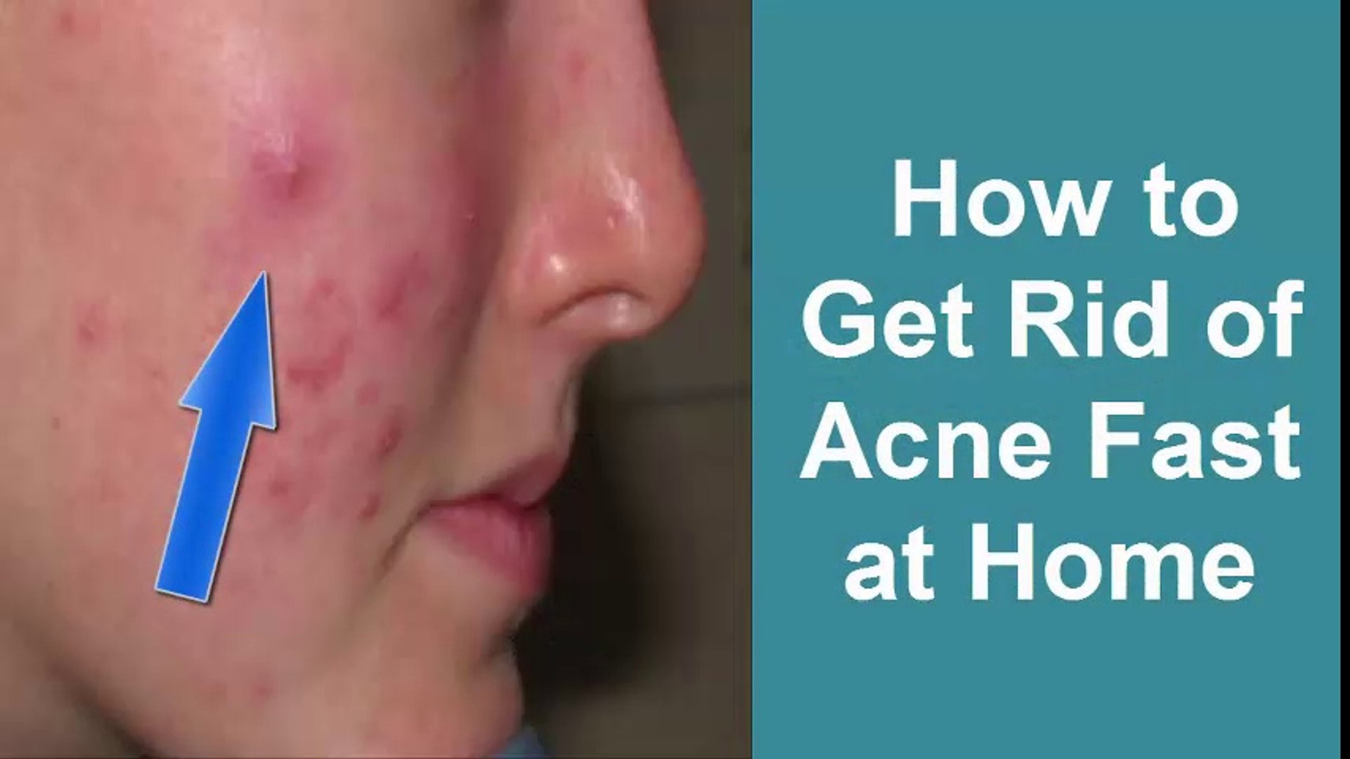 At how to overnight remove home acne How To