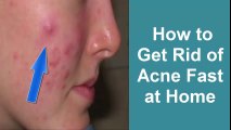 How to get rid of Acne fast at home overnight|Girls Face Beauty Tips|How to get glowing skin|pimples treatment and home remedies|Health and beauty tips
