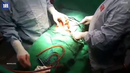 Gurin gjigant të krijuar në fshikëz, mjekët ia hoqën me levë