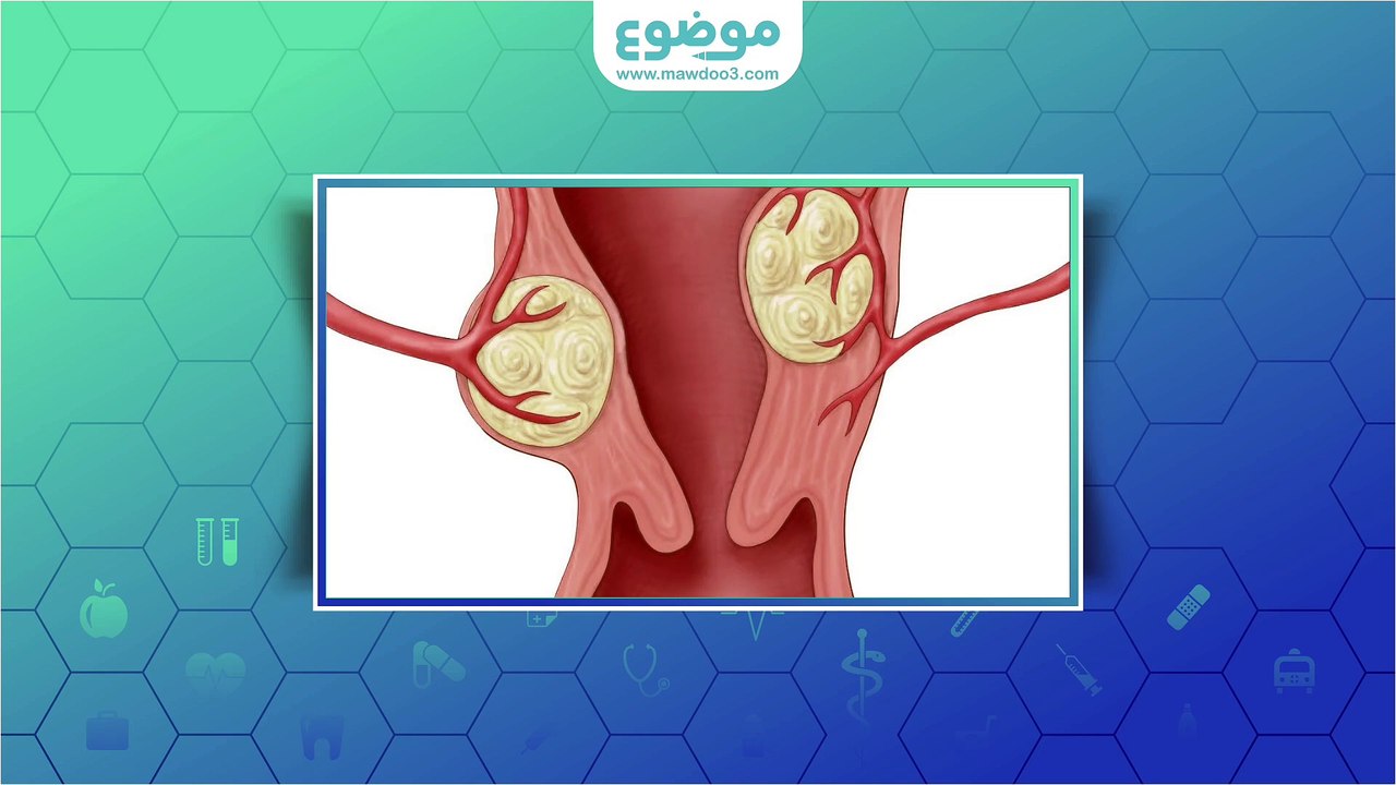 #موضوع : اعراض الالياف الرحمية