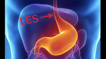 Five Things You Must Know About Reflux Disease