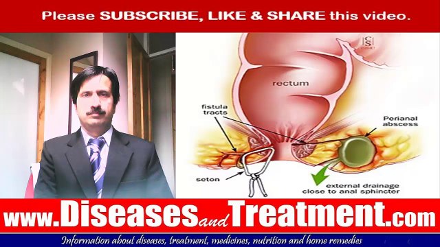 anal fistula : Causes, Symptoms, Diagnosis, Treatment, Prevention