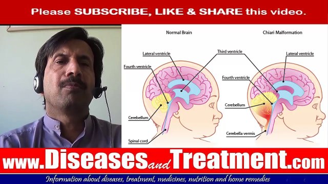 Chiari malformation- Arnold-Chiari malformation : Causes, Symptoms, Diagnosis, Treatment, Prevention