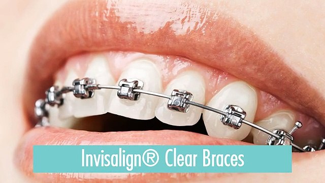 Oakbrook Orthodontics Offers Invisalign Clear Braces