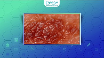 #موضوع: ما هي  #الشامات؟ ولماذا تظهر؟