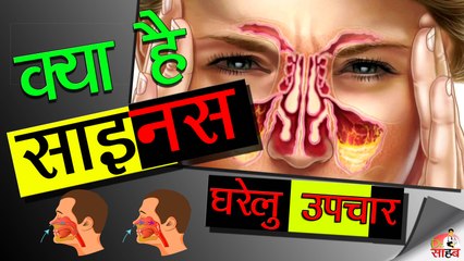 साइनस का इलाज,कारण व लक्षण घरेलु नुस्खे और योग-Sinus  Home Remedy