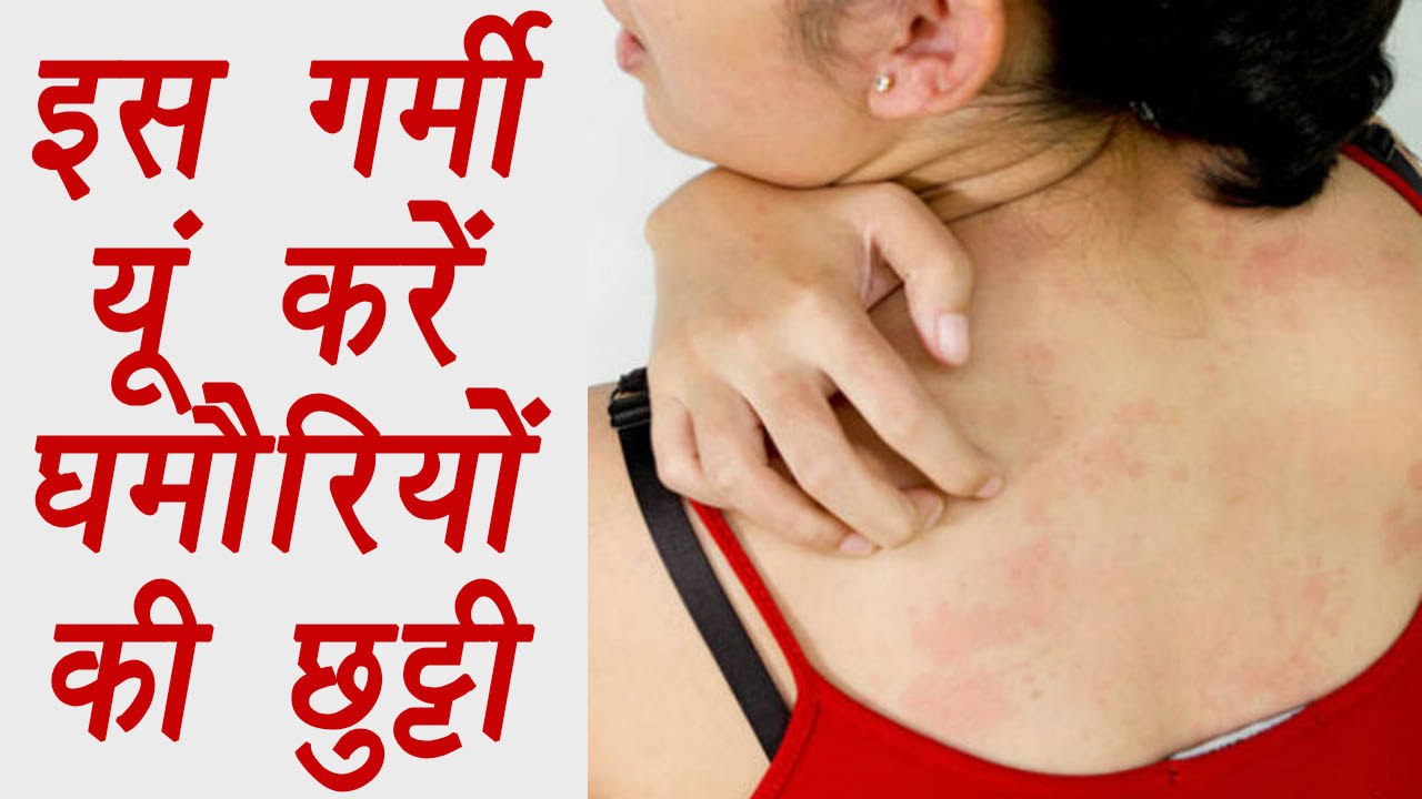 Prickly Heat Home remedies, इस गर्मी यूं करें घमौरियों की छुट्टी | BoldSky