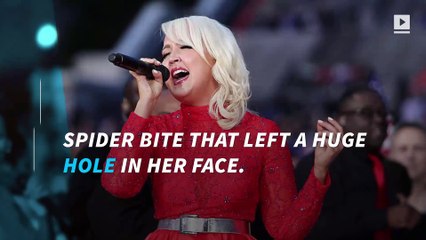 'The Voice' runner-up opens up about gruesome spider bite