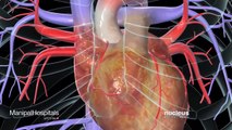 How Coronary artery bypass surgery works – Manipal Hospital