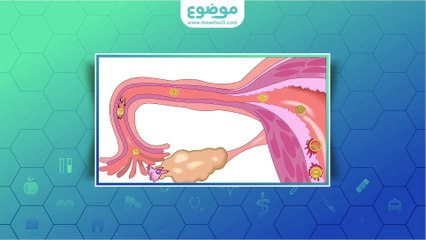 #موضوع: علاج الأكياس على المبايض