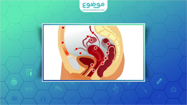 #موضوع: ما هي بطانة الرحم المهاجرة