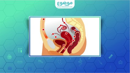 #موضوع: ما هي بطانة الرحم المهاجرة