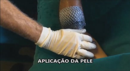 El remedio brasileño para combatir las quemaduras: la piel de pescado