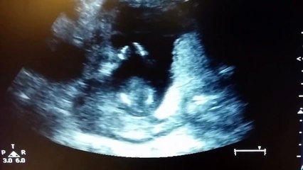 ¡Bebé da palmadas dentro del útero!