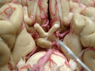 POLIGONO DE WILLIS - CIRCULO ARTERIAL CEREBRAL - CIRCLE OF WILLIS