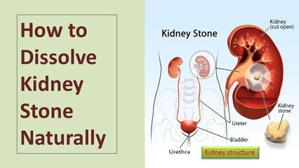 How to Dissolve Kidney Stone Naturally
