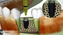 恐ろしい現代のテクノロジー歯科インプラントワークベストエヴァー