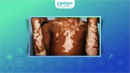 #موضوع: ما هو #البهاق؟