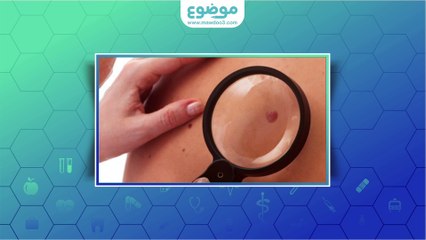 #موضوع: كيف يتم #علاج #الشامات؟